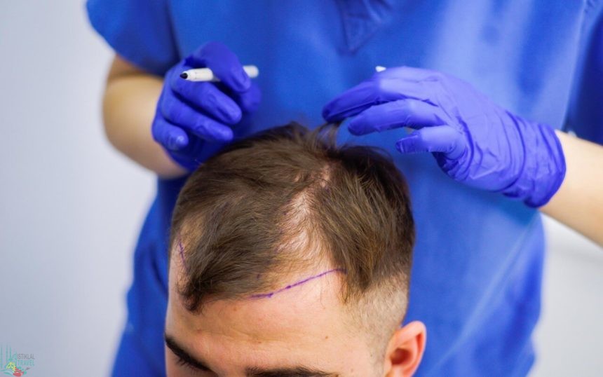 تكلفة زراعة الشعر في تركيا ٢٠٢١