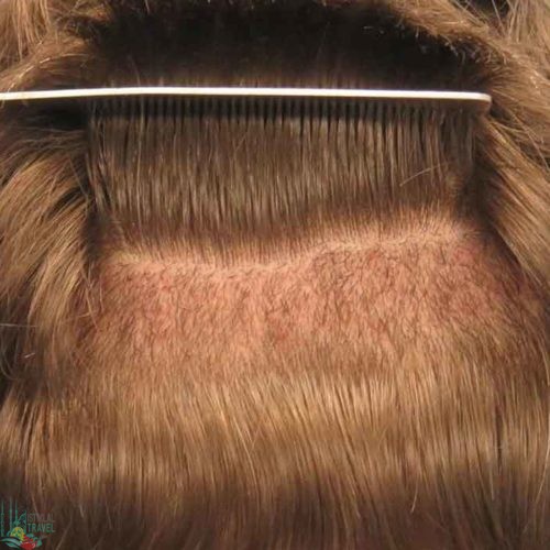 زراعة الشعر في طرابزون