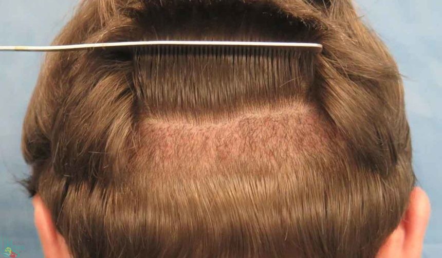 زراعة الشعر في طرابزون