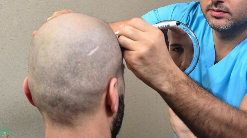 تكلفة زراعة الشعر في طرابزون