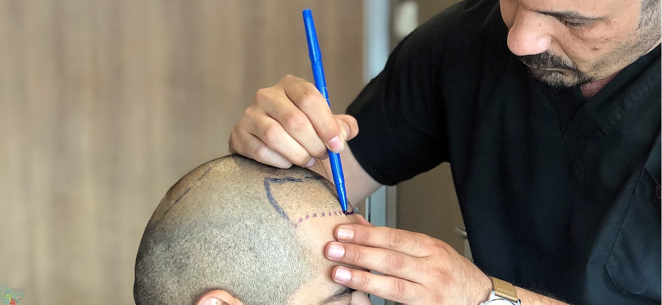 تكلفة زراعة الشعر في طرابزون